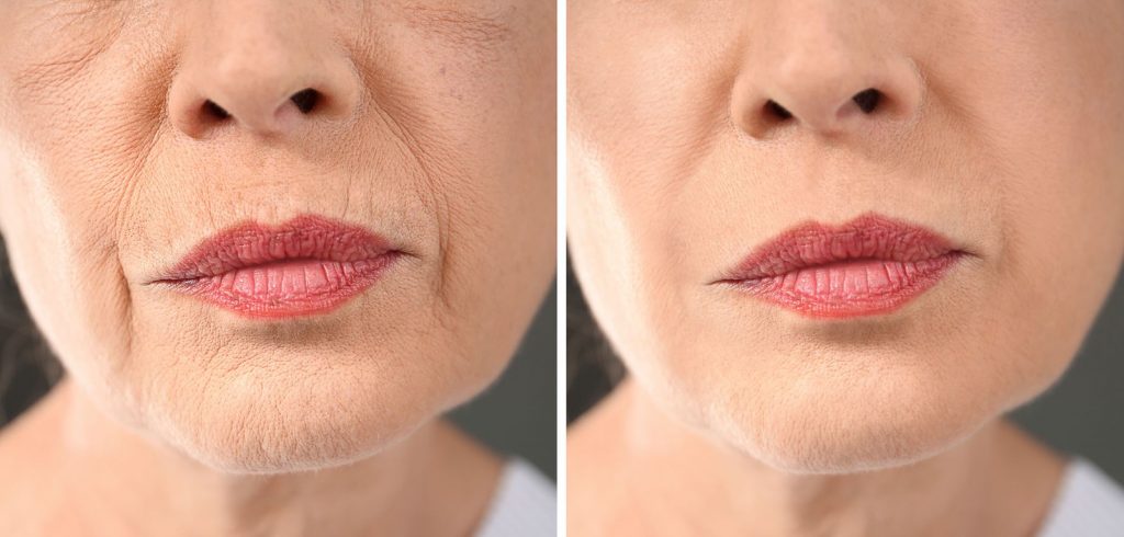 before and after anti-aging treatment