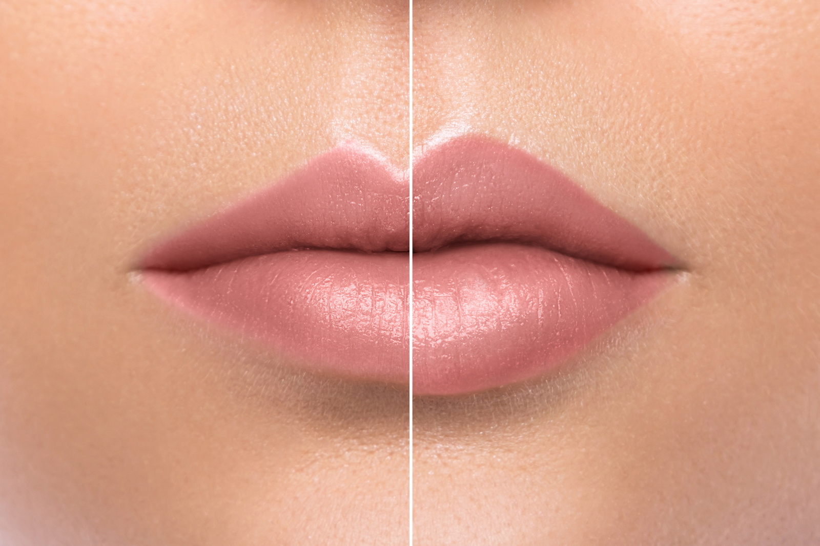 Hyaluron Infusion: Achieve Fuller Lips with the Simplest, Most Natural Treatment